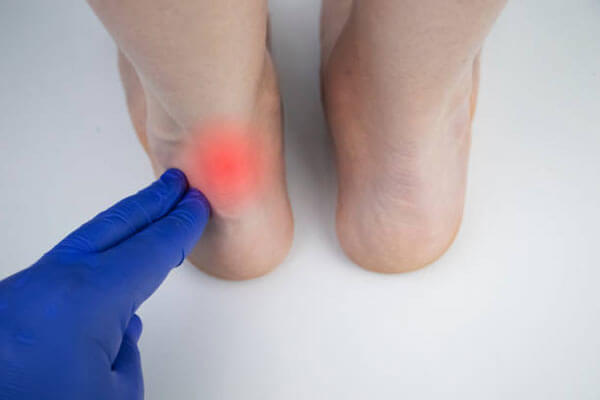 Achilles Tendonitis