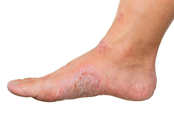 Diabetic foot problem