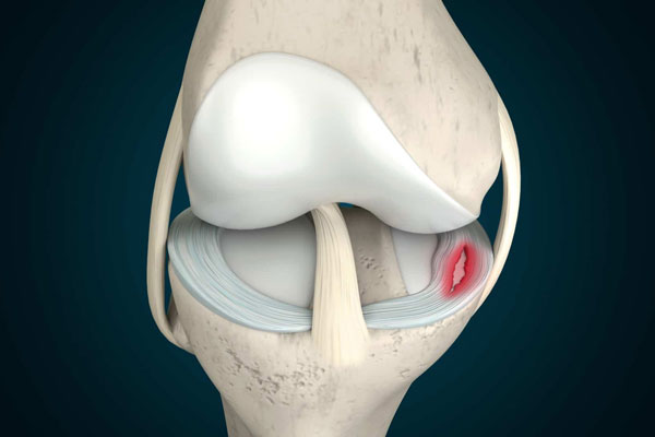 Meniscus Tear