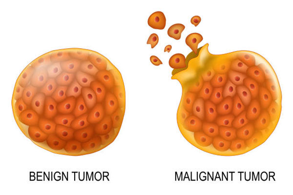 Benign Tumour