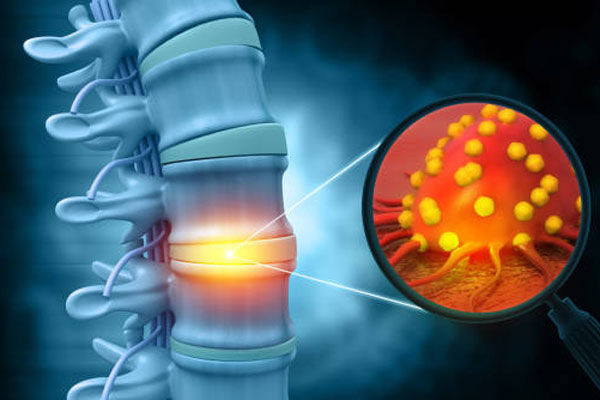 Primary cancers of the Bones (Bone Tumor)