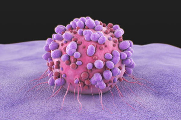 Primary Cancers of the Soft Tissues