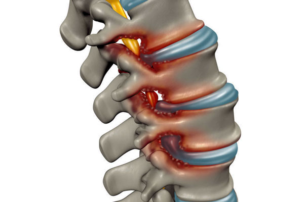 Lumbar Spinal Stenosis