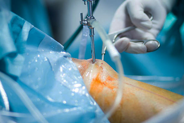 Arthroscopic Knee Surgeries