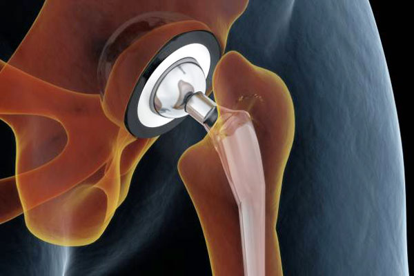 Hip Replacement