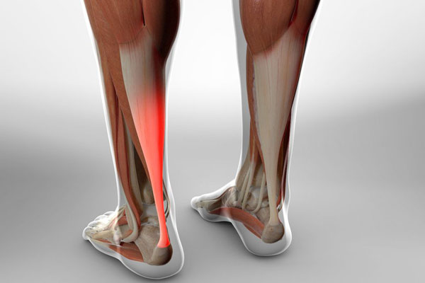 Achilles Tendon Lengthening & Repair