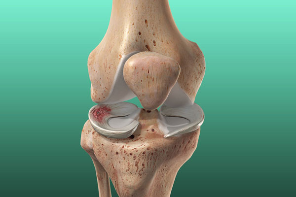 Meniscal Tear Repair