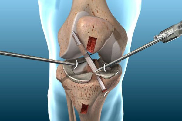 PCL Reconstruction