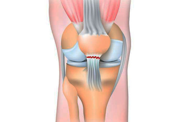 Quadriceps Tendon Rupture Repair