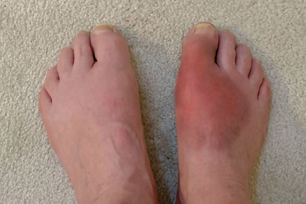 Osteotomy of the Big Toe Osteotomy of the Big Toe