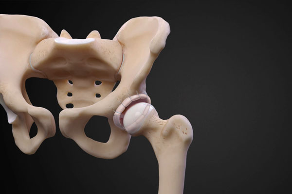 Osteotomy of the Hip