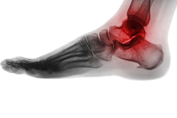 Bone Fusion Surgery on Ankle