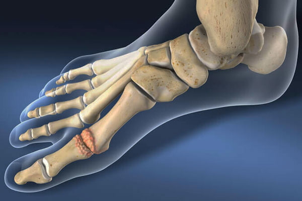 Bone Fusion Surgery on Big Toe