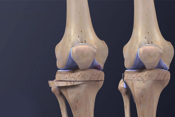 Osteotomy of the Knee