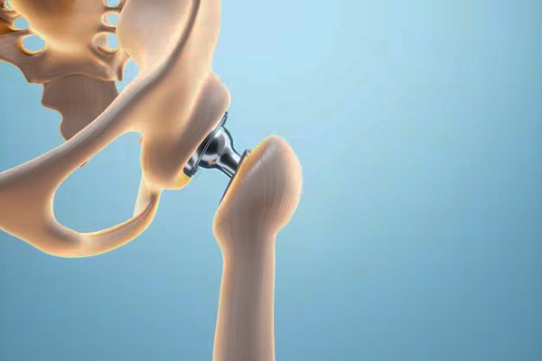 Hip Joint Revision Surgery